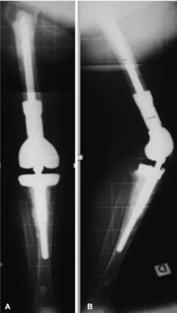 Fig. 7 Anteroposterior (A) and lateral (B) X-rays show good posi- posi-tioning of the Zimmer Segmental System at the 5-year follow-up.