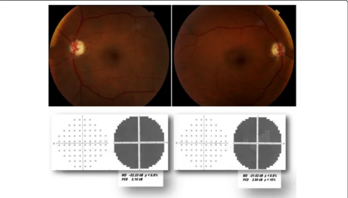 Fig. 1 (first row) Fundus photograph of both eyes showing bilateral temporal pallor of the optic disc; (second row) 8 weeks after the anterior ischemic optic neuropathies occurrence, visual field test of both eyes showing a complete defect with a very low 