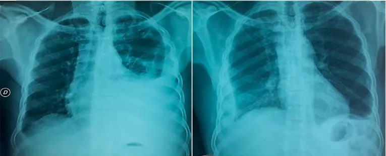Fig. 1.   Radiological and radiometabolic scenario. Chest X-rays showed the different evolution of pleural effusion 