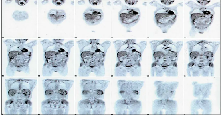 Fig. 2.   Radiological and radiometabolic scenario.   18  F-FDG positron emission tomography/CT scan with multiple 