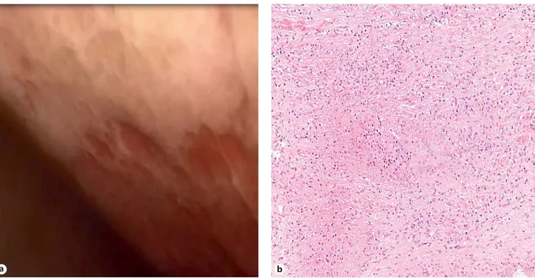 Fig. 3.   Endoscopic view and pathological examination. Thoracoscopic view (  a  ) of the right pleural cavity, show-