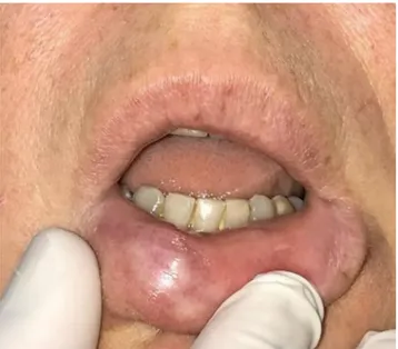 FIGURE 1  Slowly growing nodular lesion of the right lower  hemi‐lip of hard consistency, not ulcerated, painless, showing no signs  of previous infection