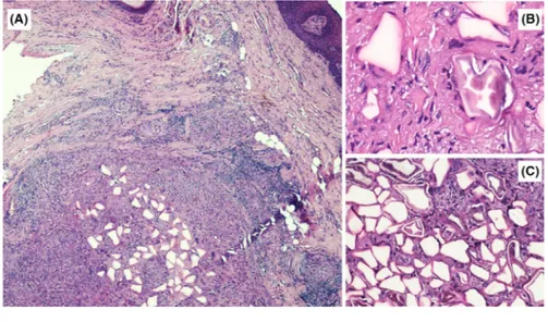 FIGURE 2  A‐C, Histologic  examination showing several clear  polygonal spaces surrounded by fibrous  collagen, small lymphocytes, macrophages  with occasional cytoplasmic clearing,  and sparse multinucleated giant cells (A,  H&amp;E, original magnificatio