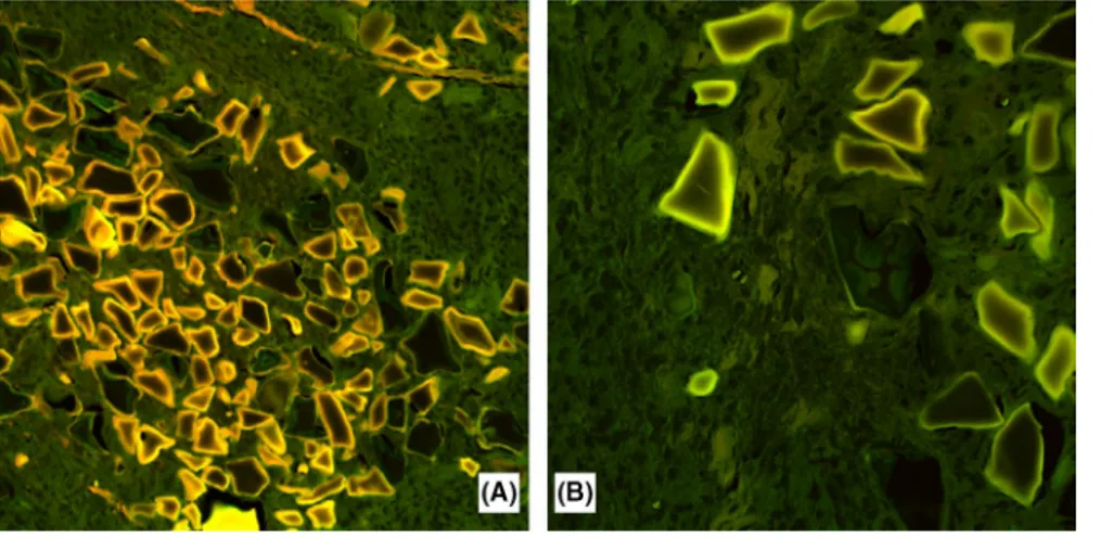 FIGURE 4  A, B, Confocal laser  scanning microscopy showing (A,  original magnification ×10) an intense  autofluorescence of the peripheral  material within the lacunae progressively  vanished toward the center with an onion‐ skin appearance
