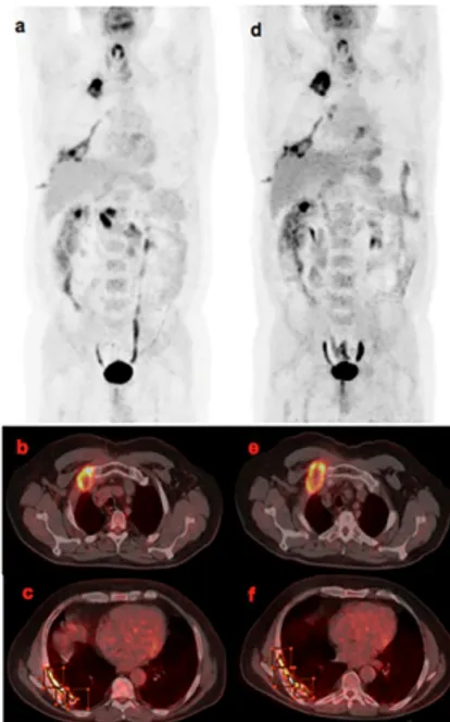 Figure 2. A non-responder patient, male, aged 72 with relapsed MPM by “mRE-