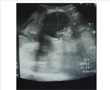 Figure 1: Nor clear anechogenic features of a cystic lesion.