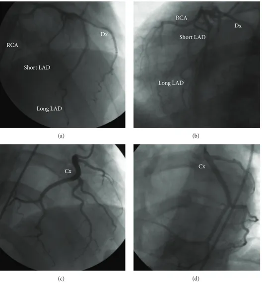 Figure 1: Coronary angiography (CRA 24 RAO 10 and CAU 24 LAO 34) showing dual LAD ((a), (b)) and (CRA 24 RAO 12 and CAU 21 LAO 32) lone Cx giving off the posterior descending artery ((c), (d))