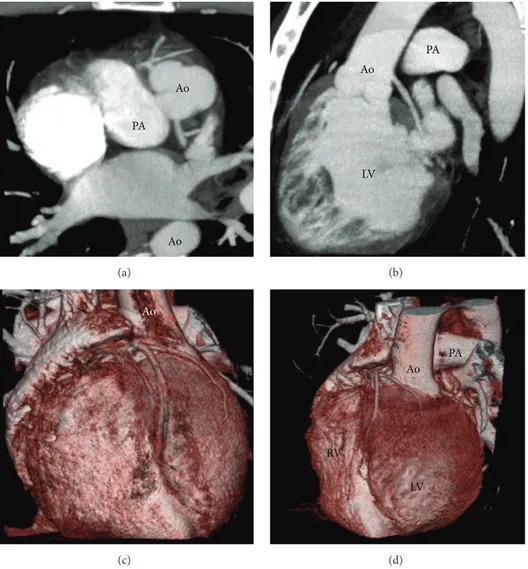 Figure 2: Paraxial (a) and parasagittal (b) maximum intensity projection reconstruction from cardiac CT scan, demonstrating the anomalous site of the coronary ostia as well as the malposition of the great arteries, confirmed by 3D volume-rendered reconstru