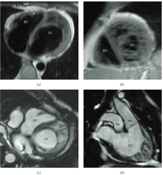 Figure 3: Cardiac MRI long axis (a) and short axis (b) black blood fast spin echo images of LV, with end-diastolic long axis ((c), (d)) cine balanced steady-state free precession acquisition, confirming the presence of the anatomic features of NC in the mi