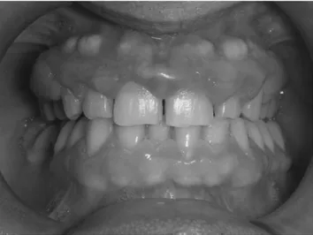 FIG. 2. Panoramic radiograph demonstrates the presence of diffuse pseudogingival pockets; no periodontal bone  le-sions are detectable.
