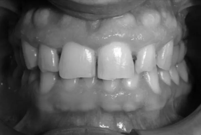 FIG. 5. After 2 months, during clinical follow-up, no signs of periodontal inflammation were detectable and gingiva showed a normal appearance; for this reason, no additional surgical procedure has been necessary.