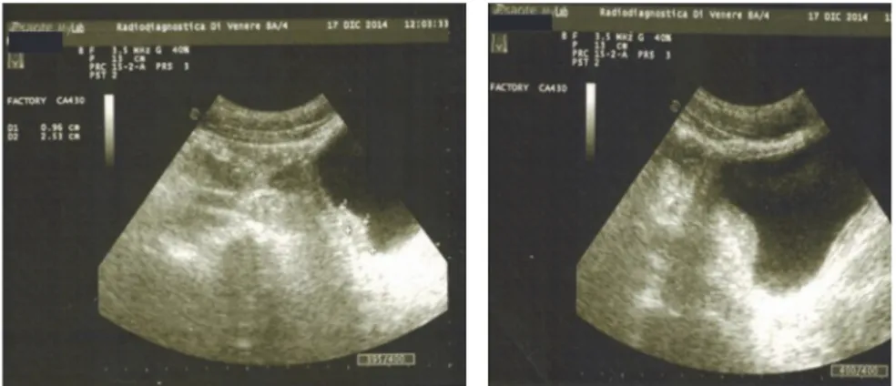 Figure 1: A hyperechoic intraluminal nonmobile vegetations of the bladder wall.