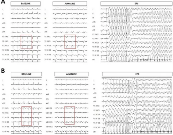 Figure 4. Electrocardiogram at baseline, after ajmaline administration, and ventricular tachycardia/ventricular fibrillation inducibility during electrophysiological study (EPS) for the proband’s mother (A) and sister (B)