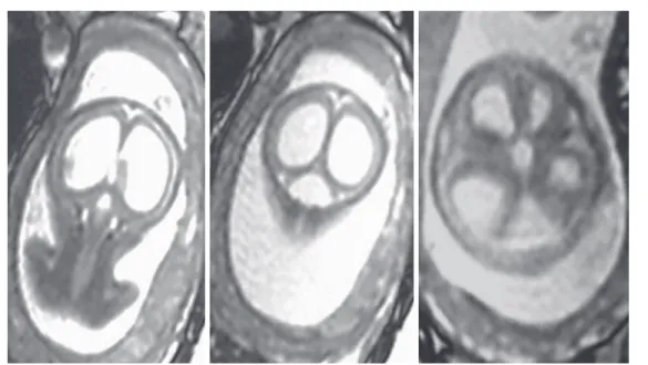 Fig. 17: 24 gestational weeks. HASTE T2 images in selected coronal and axial planes. Classical  DWM with cystic dilatation of fourth ventricle and severe ventriculomegaly