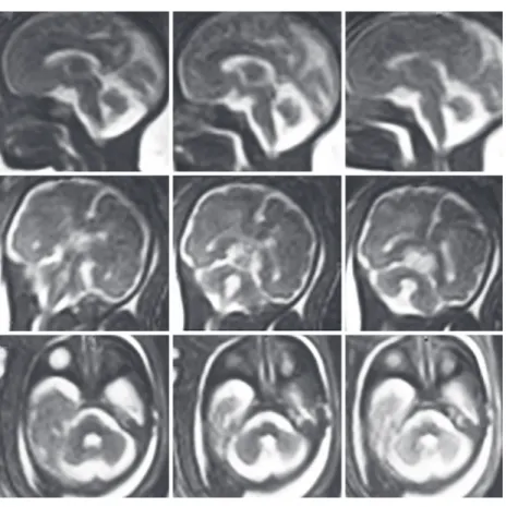 Fig.  19:  32  gestational  weeks.  HASTE  T2  images  in  selected  axial,  coronal,  and sagittal planes