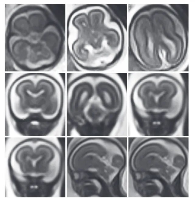 Fig. 1: 19 gestational weeks. Normal fetal brain. HASTE T2 images in selected axial, coronal, and sagittal  planes