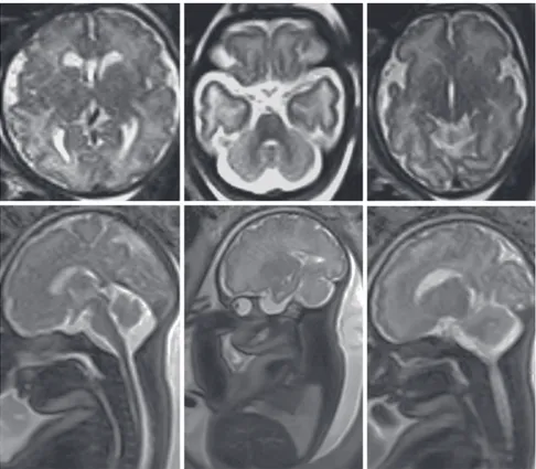 Fig. 3: 32 gestational weeks. Normal fetal brain. HASTE T2 images in selected axial  and sagittal planes