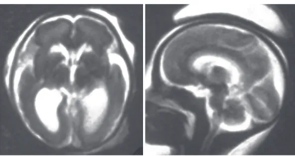 Fig. 6: 22 gestational weeks. HASTE T2 images in selected axial and sagittal planes. Ultrasound diagnosis  of mild bilateral ventriculomegaly