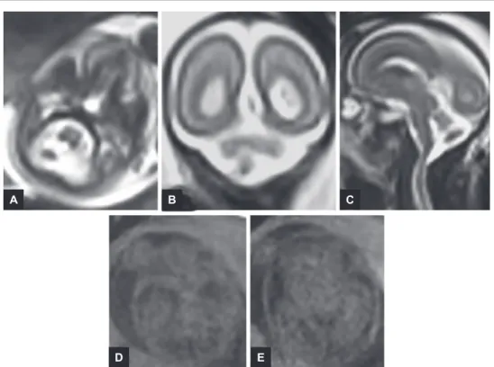 Fig. 9: 37 gestational weeks. HASTE T2 images in selected axial, coronal, and sagittal planes