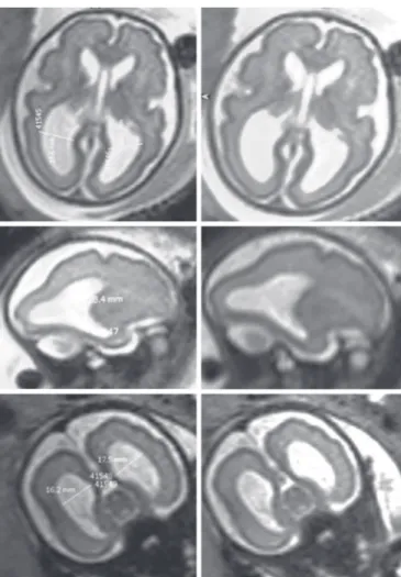 Fig. 14: 22 gestational weeks. HASTE T2 images in selected axial, coronal, and sagittal planes