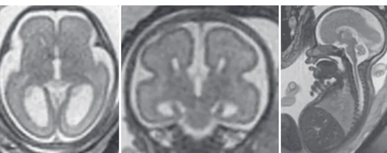 Fig. 15: 25 gestational weeks. HASTE T2 images in selected axial, coronal, and sagittal planes