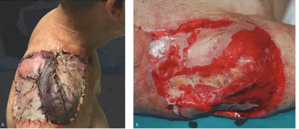 Figure 1: 50-year-old patient affected by shoulder sarcoma after tumor excision and reconstruction with pedicled latissimus dorsi flap and skin grafts