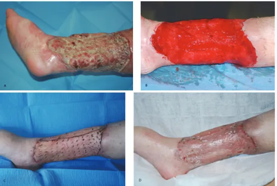 Figure 4: 45-year-old patient affected by chronic infected lower limb ulcer. (A) Recovery time (cultural examinations were positive for