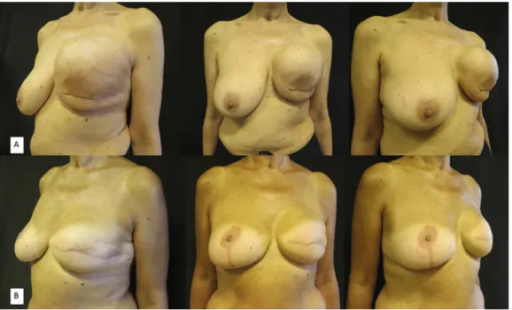 Figure 2. A) A 65-year-old patient presented with unilateral breast reconstruction by means of an expander (550 cc) and con- con-tralateral moderate breast ptosis