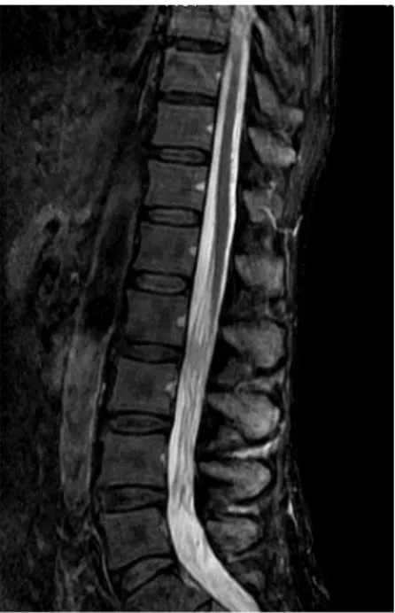 Figure  2.  Magnetic  resonance  imaging  of spinal  cord  (T2  image):  pathological   tis-sue  infiltrating  cauda  equine,  mainly  in the  vertebral  body  of  L3,  and   interverte-bral space between L2-L3.