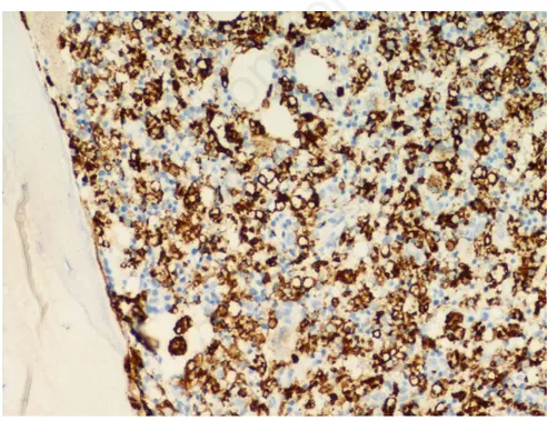 Figure 3. Bone marrow biopsy: CD68 immunostain shows a diffuse histocyte infiltrate in hypercellular marrow.