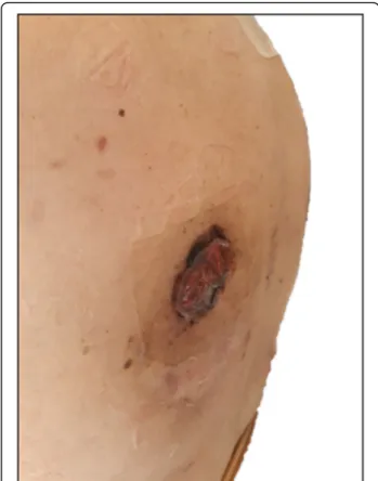 Fig. 5 Clinical response of the irradiated skin lesion at the right scapular region