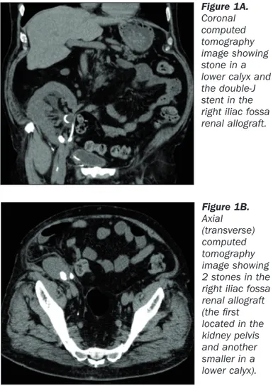 Figure 2B.  Coronal computed tomography image showing stone in the distal part of the transplanted ureter.