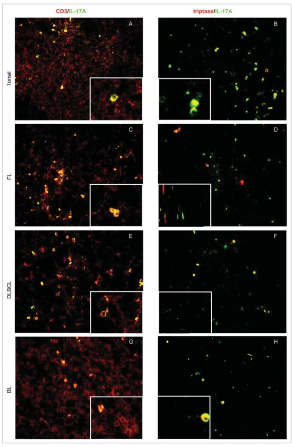 Figure 6. Expression of IL-17A in normal and neoplastic GC microenvironment. (A –H) Double-marker immunoﬂuorescence analysis of IL-17A C cells within reactive tonsil tissue, and in the neoplastic in ﬁltrates of FL, DLBCL, and BL samples