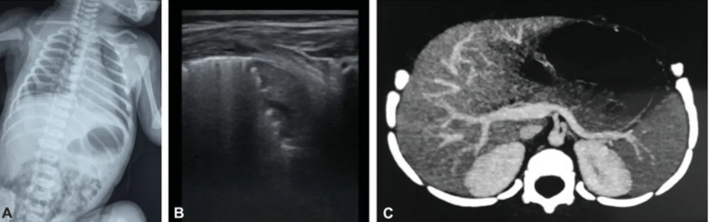 Fig. 3 (A) CXR: left-sided diaphragmatic elevation. (B) LUS: pulmonary consolidation of the left lower lobe