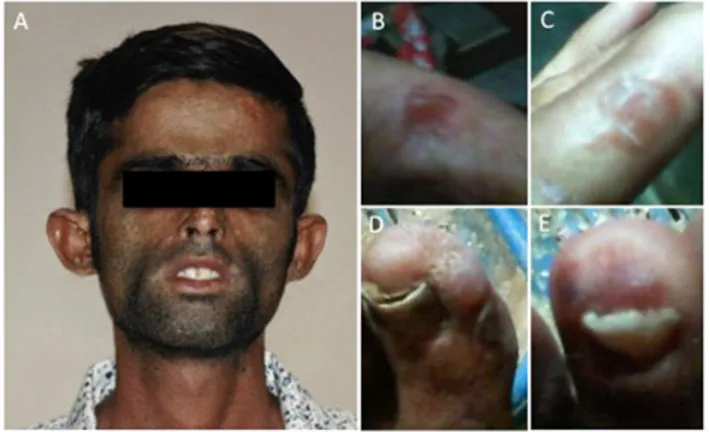 Figure 1. One of the two Pakistanis brothers with signs of CEP (patient 1). A. Evi- Evi-dence of yellow teeth coloration and hypertrichosis; B, C Fingers with red bullae  and blisters prone to rupture and; D, E