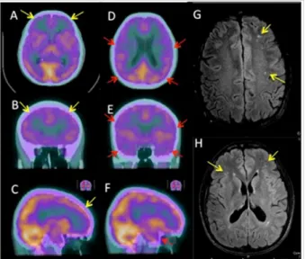 Figure 4. Brain perfusion SPET/CT (A-F) and related MRI imaging  ndings (G-H)  of patient 2, axial (A, D, G, H), coronal (B, E) and sagittal (C, F) slices