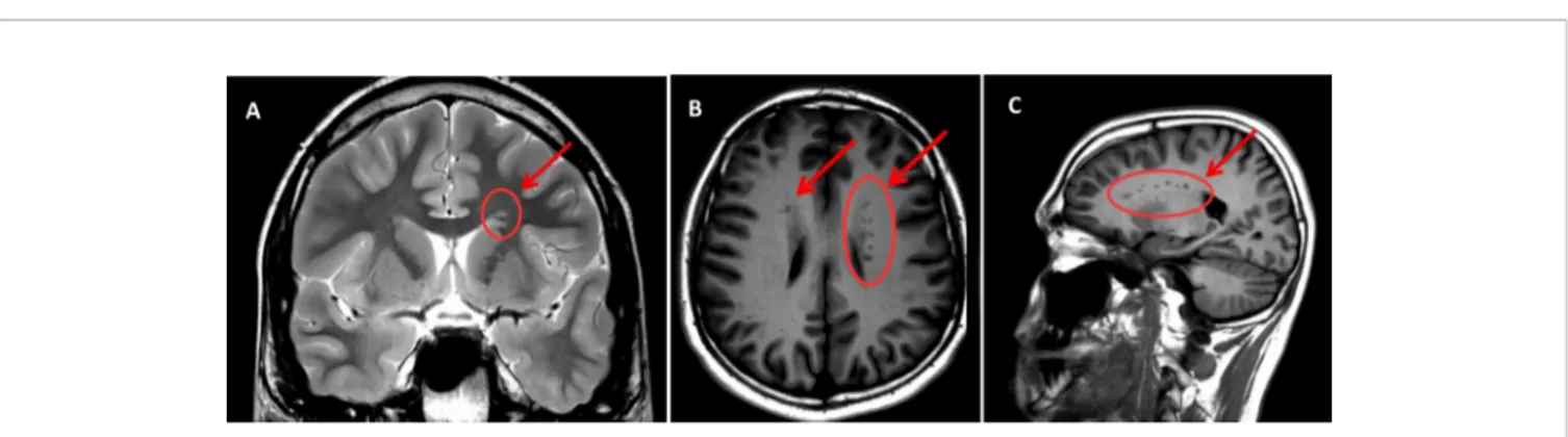 FIGURE 1 | MRI scan sections of the patient's brain reporting the presence of GMH (indicated by arrows and circles)