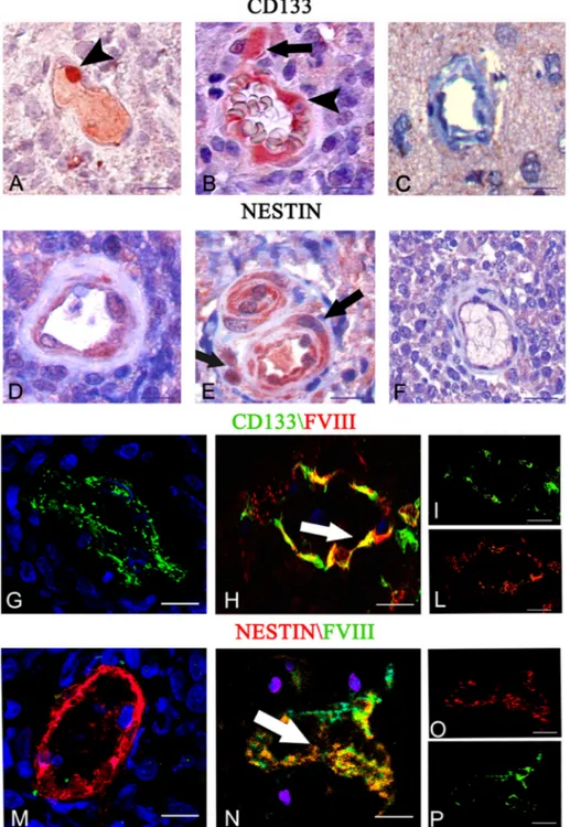 Figure 4:  CD133 and nestin immunohistochemistry (A–F) and CD133 (green)/FVIII (red) (G–L), and nestin (red) /FVIII (green) (M–O)  confocal dual immunofluorescence reaction