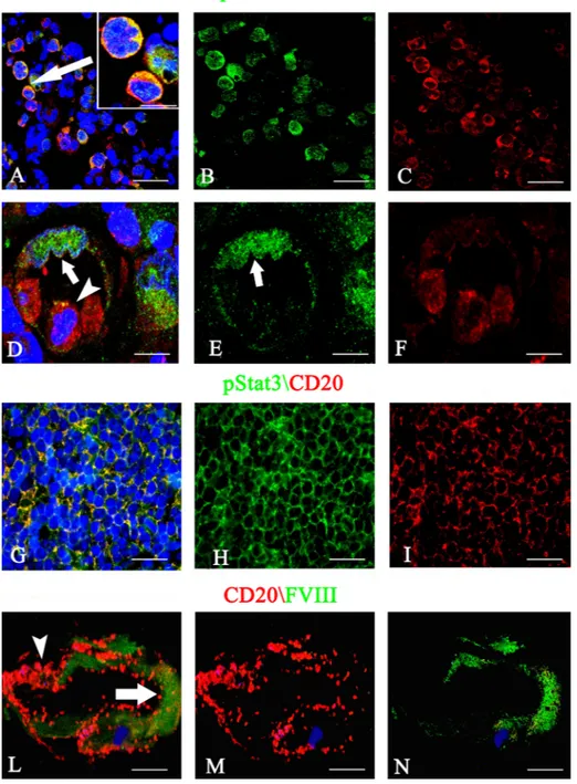 Figure 5:  pStat3/CD133 (A–F), pStat3/CD20 (G–I) and CD20/FVIII (L–N) confocal dual immunofluorescence reaction