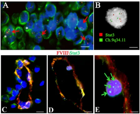 Figure 9:  Tetraploid CD20 positive cells in PCNSL tissues and Tetraploid Stat3 positive cells in PCNSL vessels investigated by FICTION  (A, C, D) and FISH (B) analysis