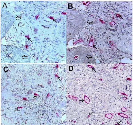Figure 5. (A,C) Bone metastases from gastric cancer tissue sections. Small arrows indicate  single  red  immunostained  mast  cells