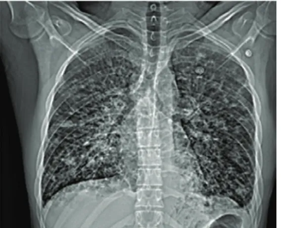 Figure 1 Chest radiograph showing bilateral nodular  opacities with a lower zone predominance, interstitial   thickening and pleural effusion on the left.