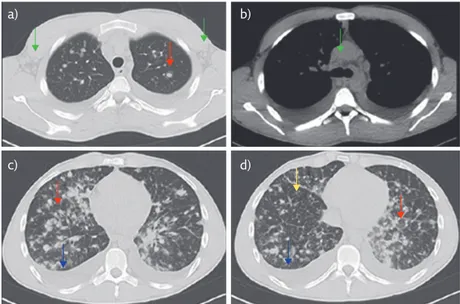 Figure 2  Chest CT (axial view) with parenchymal (a, c and d) and mediastinal windows (b)