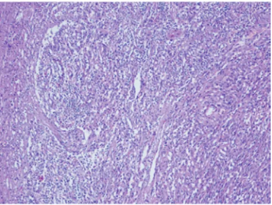 Figure 3 Histological findings from surgical biopsy of  the right inguinal lymph nodes: fascicles of monomorphic  spindle cells and vascular structure mixed with chronic  infil-trates