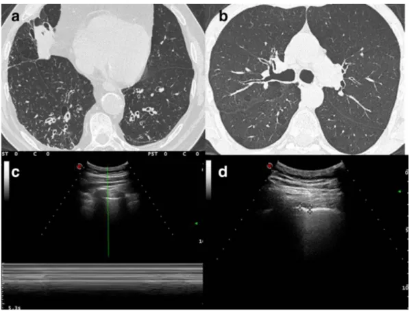 Figure 1. (A, B) HRCT imaging shows overdistension and the airway wall thickening with bronchiectasis of lung bases; in addition,  it shows also centrilobular micronodular lesions which state distal airway inflammation
