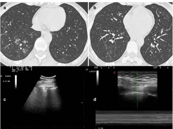 Figure 2. (A) HRCT imaging shows bronchial wall thickening, endobronchial nodules in segmental and subsegmentary bronchi of  the lower left lobe