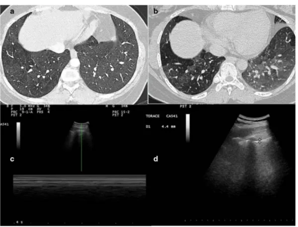 Figure 3. (A, B) HRCT scans show minimal thickening of the bronchial walls and a slightly inhomogeneous appearance of the lung  parenchyma (a mild picture of “mosaic oligohemia”)