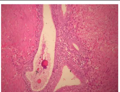 Figure 2. Histopathology of Kaposi sarcoma showing vascular slits surrounded by spindle cells and granulocites and midle mitoitc activity [hematoxylin and eosin (HE) staining; magni ﬁcation 200].