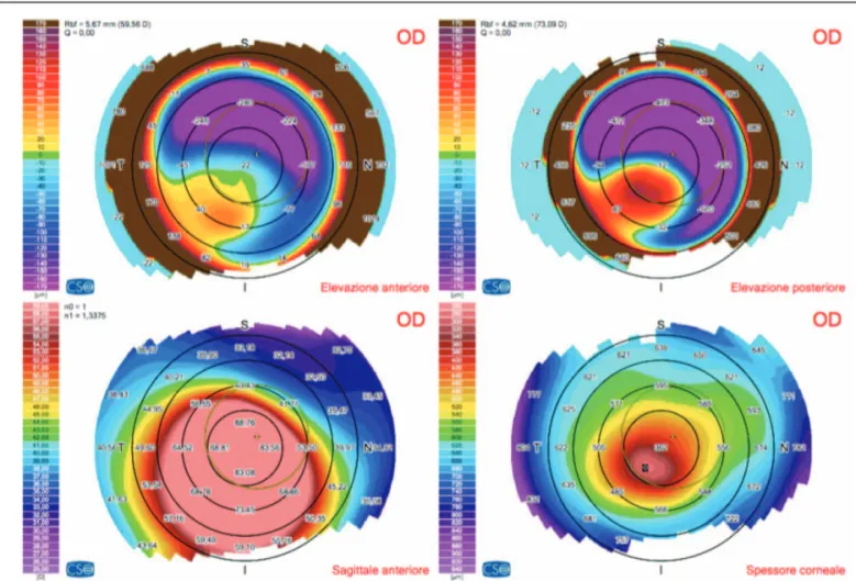 Figure 1. Topography showed an infero-temporal paracentral corneal steepening. Sim-K reading were 62.08 D and 72.68 D in the ﬂat and steep axis respectively,