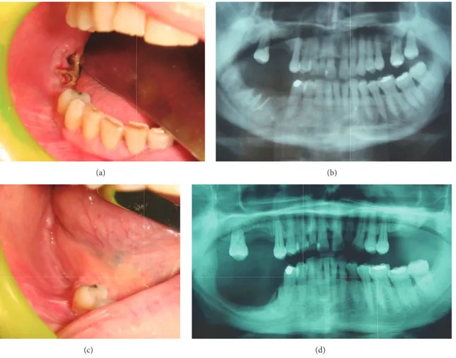 Figure 2: At clinical examination, presence of postextractive necrotic bone exposure on the right mandible (a) of a female 51-year-old patient affected by breast cancer who underwent denosumab administration 9 times